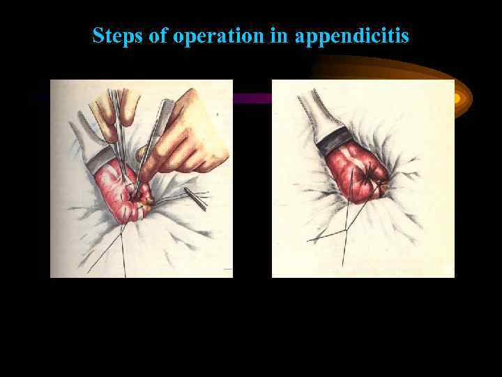 Steps of operation in appendicitis 