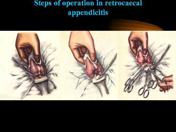 Steps of operation in retrocaecal appendicitis 