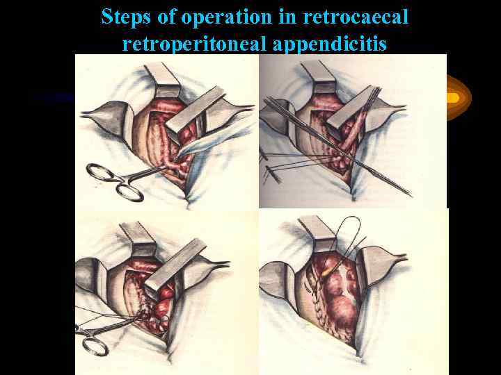 Steps of operation in retrocaecal retroperitoneal appendicitis 