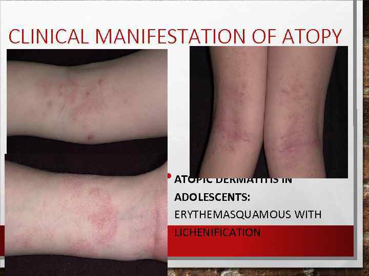 CLINICAL MANIFESTATION OF ATOPY • ATOPIC DERMATITIS IN ADOLESCENTS: ERYTHEMASQUAMOUS WITH LICHENIFICATION 