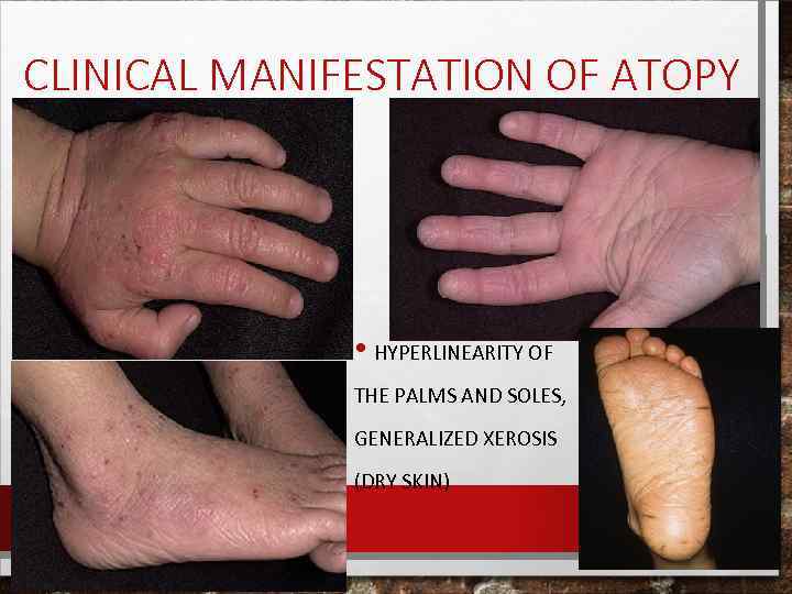 CLINICAL MANIFESTATION OF ATOPY • HYPERLINEARITY OF THE PALMS AND SOLES, GENERALIZED XEROSIS (DRY