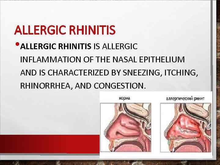 ALLERGIC RHINITIS • ALLERGIC RHINITIS IS ALLERGIC INFLAMMATION OF THE NASAL EPITHELIUM AND IS