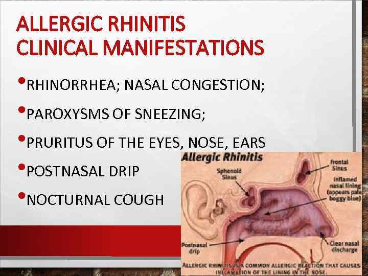 ALLERGIC RHINITIS CLINICAL MANIFESTATIONS • RHINORRHEA; NASAL CONGESTION; • PAROXYSMS OF SNEEZING; • PRURITUS