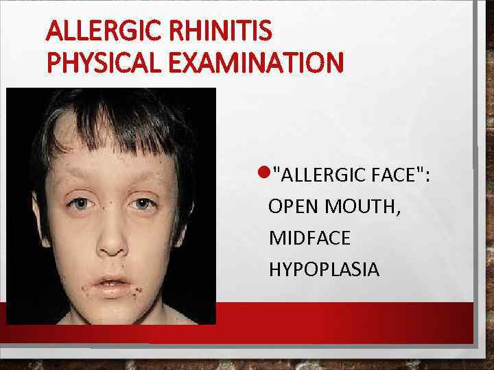 ALLERGIC RHINITIS PHYSICAL EXAMINATION 