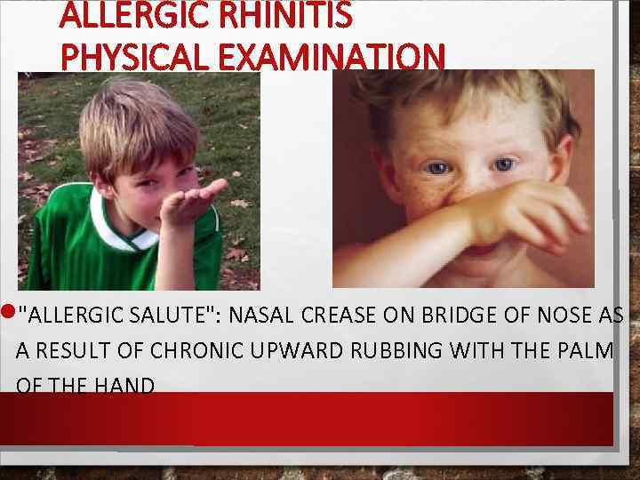 ALLERGIC RHINITIS PHYSICAL EXAMINATION 