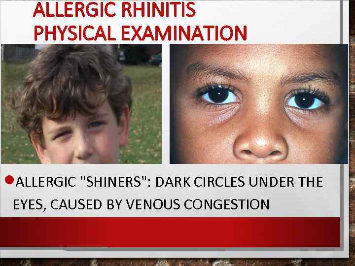 ALLERGIC RHINITIS PHYSICAL EXAMINATION ALLERGIC 