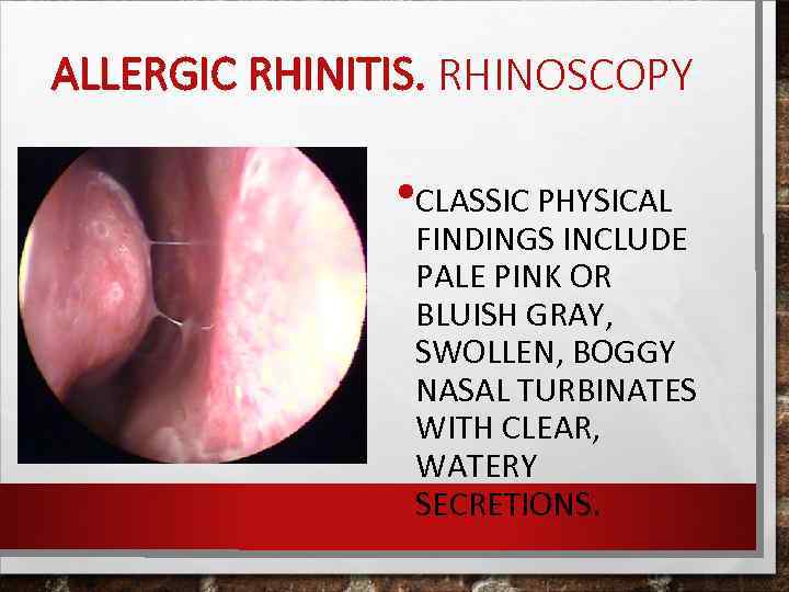 ALLERGIC RHINITIS. RHINOSCOPY • CLASSIC PHYSICAL FINDINGS INCLUDE PALE PINK OR BLUISH GRAY, SWOLLEN,