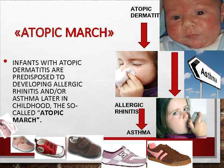 ATOPIC DERMATITIS «ATOPIC MARСH» • INFANTS WITH ATOPIC DERMATITIS ARE PREDISPOSED TO DEVELOPING ALLERGIC