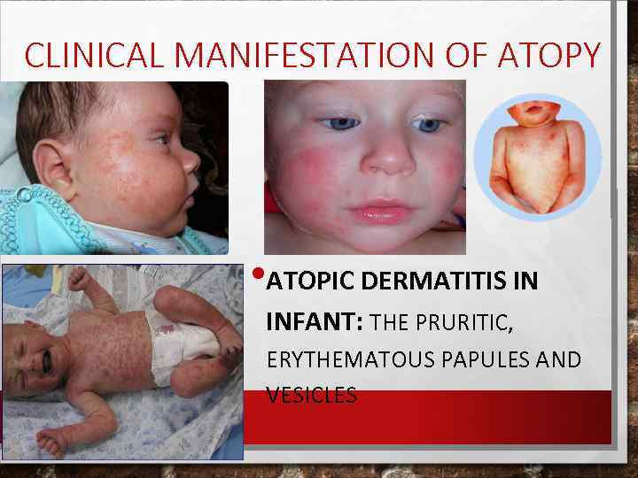 CLINICAL MANIFESTATION OF ATOPY • ATOPIC DERMATITIS IN INFANT: THE PRURITIC, ERYTHEMATOUS PAPULES AND