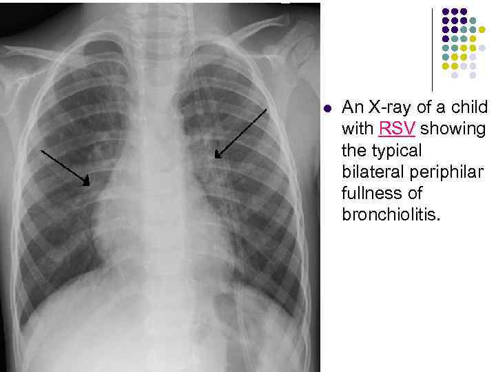 l An X-ray of a child with RSV showing the typical bilateral periphilar fullness