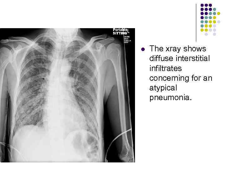 l The xray shows diffuse interstitial infiltrates concerning for an atypical pneumonia. 