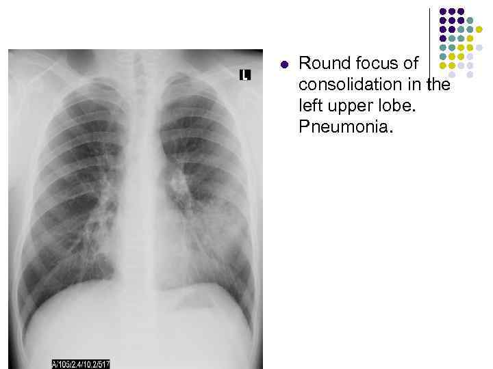 l Round focus of consolidation in the left upper lobe. Pneumonia. 