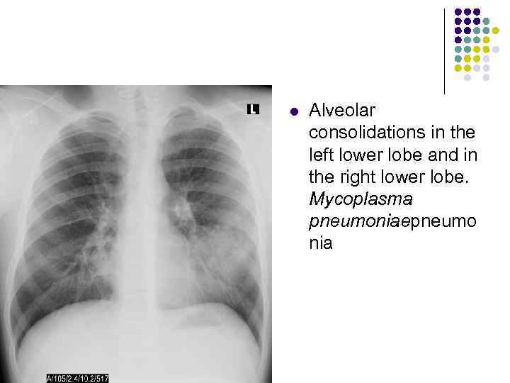 l Alveolar consolidations in the left lower lobe and in the right lower lobe.