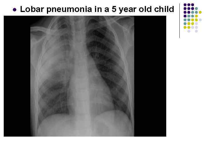 l Lobar pneumonia in a 5 year old child 