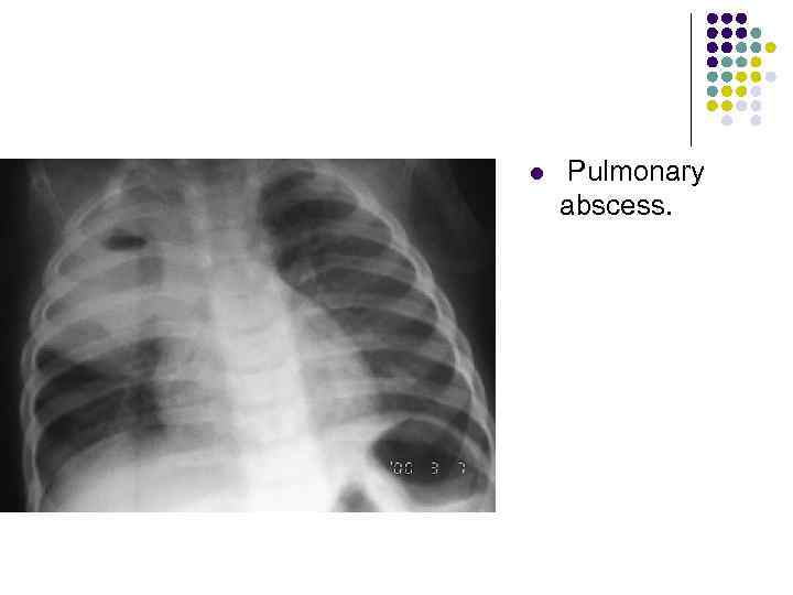 l Pulmonary abscess. 