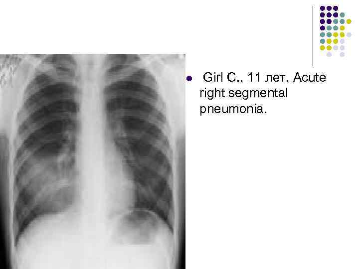 l Girl С. , 11 лет. Acute right segmental pneumonia. 