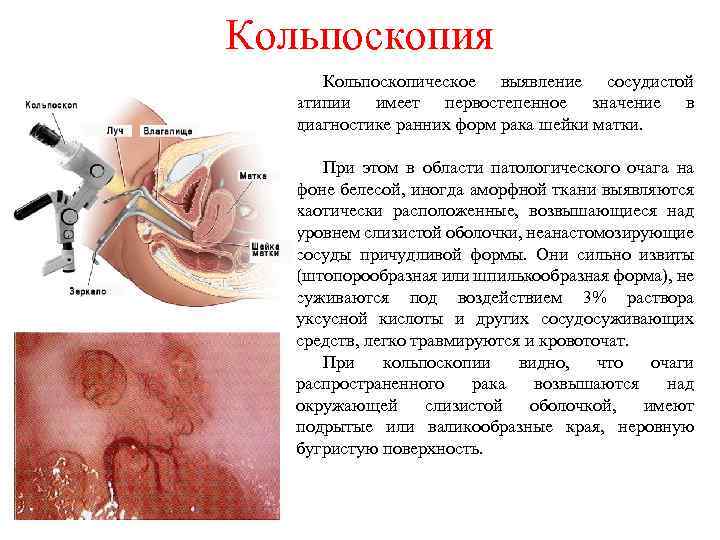 Кольпоскопия Кольпоскопическое выявление сосудистой атипии имеет первостепенное значение в диагностике ранних форм рака шейки