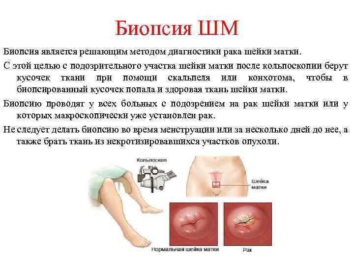 Биопсия ШМ Биопсия является решающим методом диагностики рака шейки матки. С этой целью с