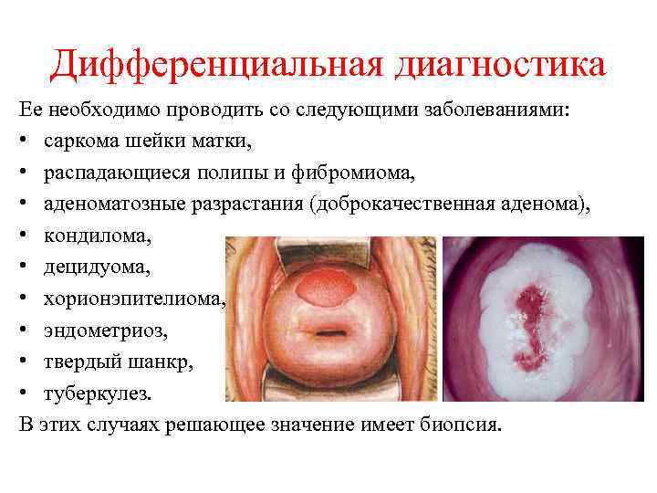 Дифференциальная диагностика Ее необходимо проводить со следующими заболеваниями: • саркома шейки матки, • распадающиеся