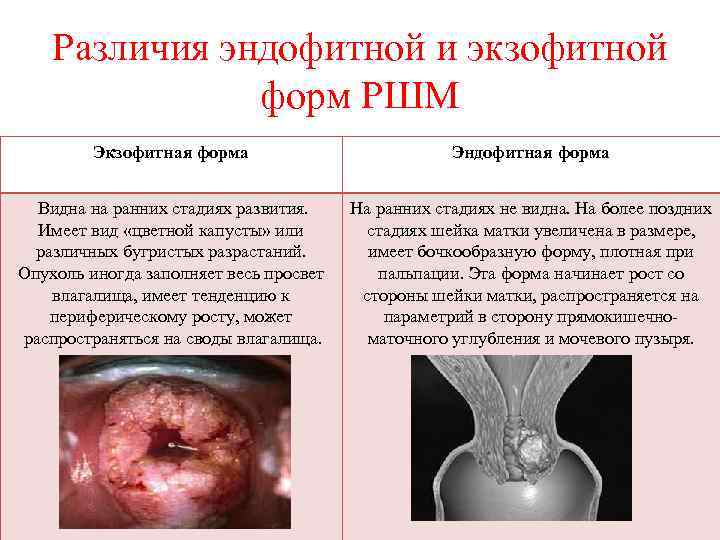 Различия эндофитной и экзофитной форм РШМ Экзофитная форма Эндофитная форма Видна на ранних стадиях