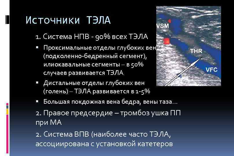 Источники ТЭЛА 1. Система НПВ - 90% всех ТЭЛА Проксимальные отделы глубоких вен (подколенно-бедренный