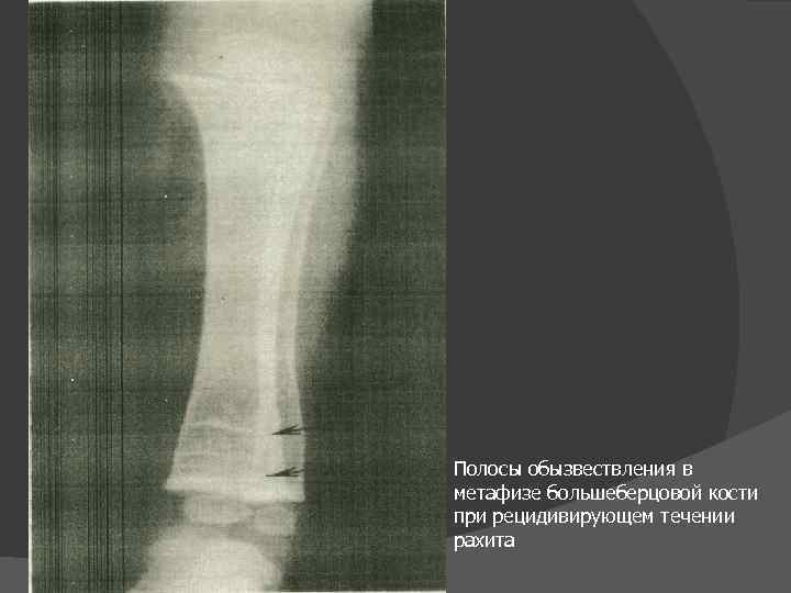 Рентгенологическая картина в период разгара рахита характеризуется