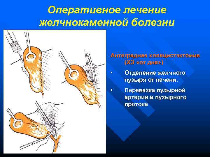 Оперативное лечение желчнокаменной болезни Антеградная холецистэктомия (ХЭ «от дна» ) • Отделение желчного пузыря