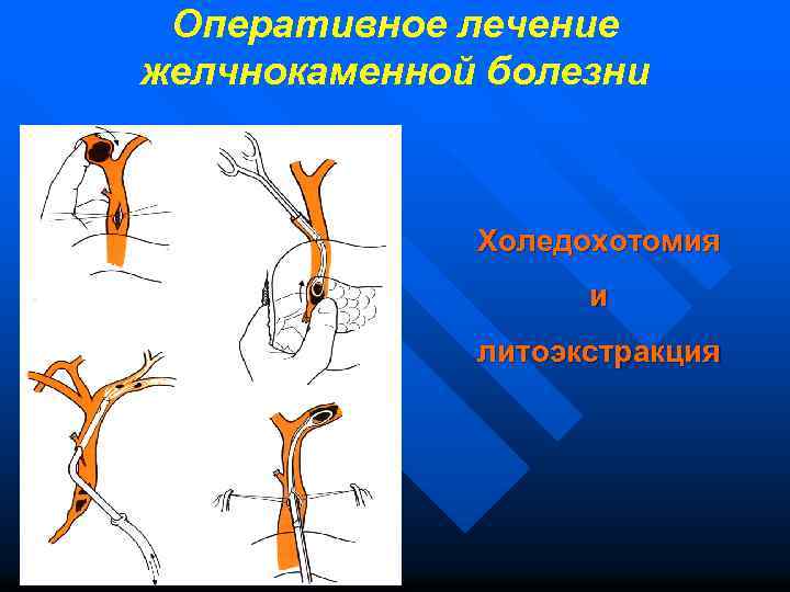 Оперативное лечение желчнокаменной болезни Холедохотомия и литоэкстракция 