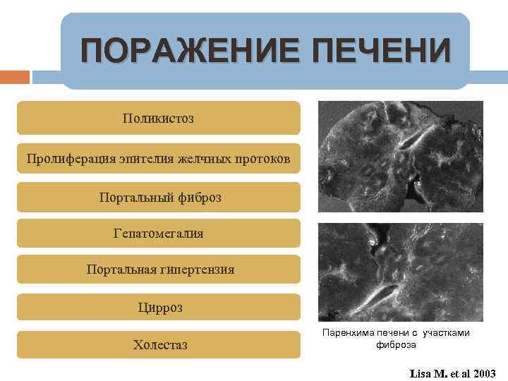 ПОРАЖЕНИЕ ПЕЧЕНИ Поликистоз Пролиферация эпителия желчных протоков Портальный фиброз Гепатомегалия Портальная гипертензия Цирроз Холестаз