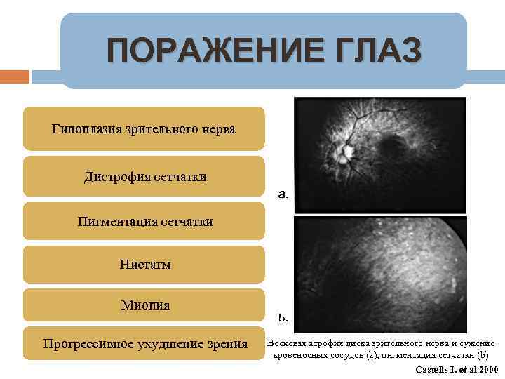 ПОРАЖЕНИЕ ГЛАЗ Гипоплазия зрительного нерва Дистрофия сетчатки а. Пигментация сетчатки Нистагм Миопия Прогрессивное ухудшение