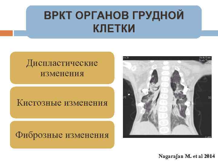 ВРКТ ОРГАНОВ ГРУДНОЙ КЛЕТКИ Диспластические изменения Кистозные изменения Фиброзные изменения Nagarajan M. et al