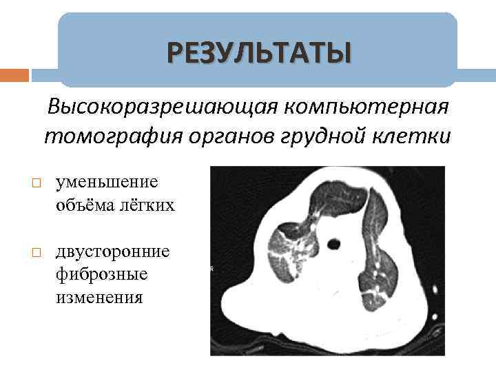 РЕЗУЛЬТАТЫ Высокоразрешающая компьютерная томография органов грудной клетки уменьшение объёма лёгких двусторонние фиброзные изменения 