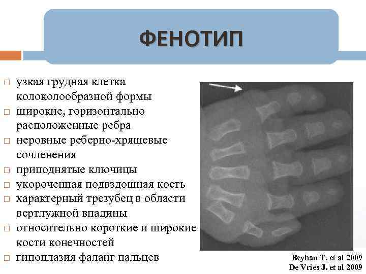 ФЕНОТИП узкая грудная клетка колообразной формы широкие, горизонтально расположенные ребра неровные реберно-хрящевые сочленения приподнятые