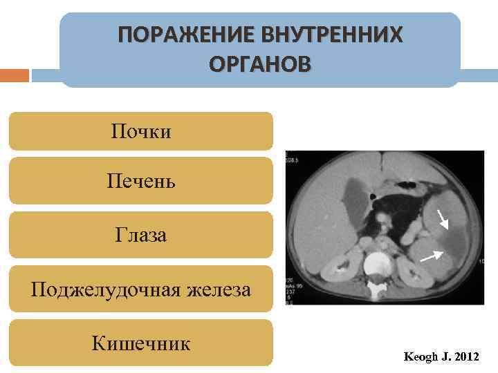 ПОРАЖЕНИЕ ВНУТРЕННИХ ОРГАНОВ Почки Печень Глаза Поджелудочная железа Кишечник Keogh J. 2012 