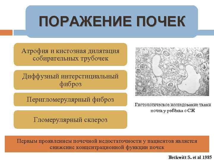 ПОРАЖЕНИЕ ПОЧЕК Атрофия и кистозная дилятация собирательных трубочек Диффузный интерстициальный фиброз Перигломерулярный фиброз Гистологическое