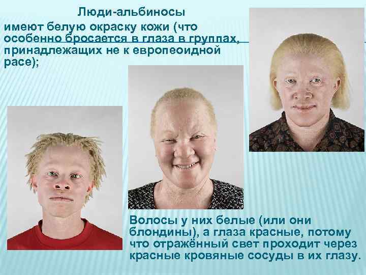 Люди-альбиносы имеют белую окраску кожи (что особенно бросается в глаза в группах, принадлежащих не
