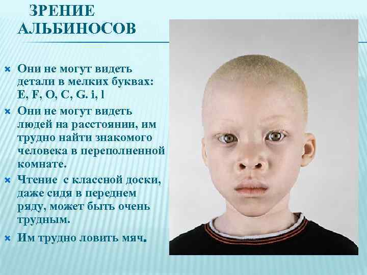 ЗРЕНИЕ АЛЬБИНОСОВ Они не могут видеть детали в мелких буквах: E, F, O, C,
