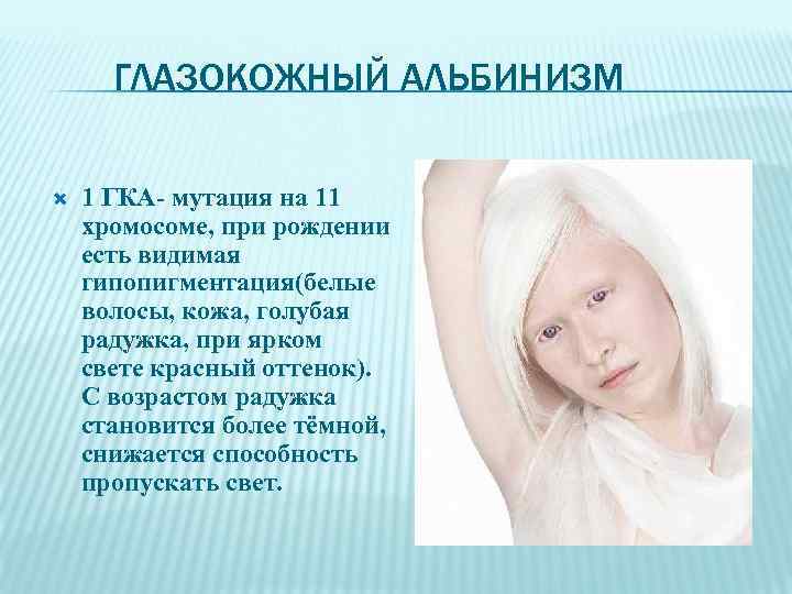 ГЛАЗОКОЖНЫЙ АЛЬБИНИЗМ 1 ГКА- мутация на 11 хромосоме, при рождении есть видимая гипопигментация(белые волосы,