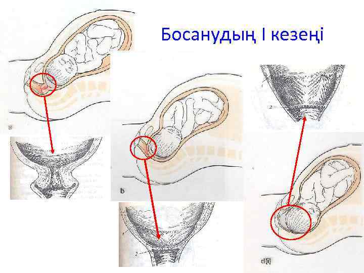 Босанудың I кезеңі 