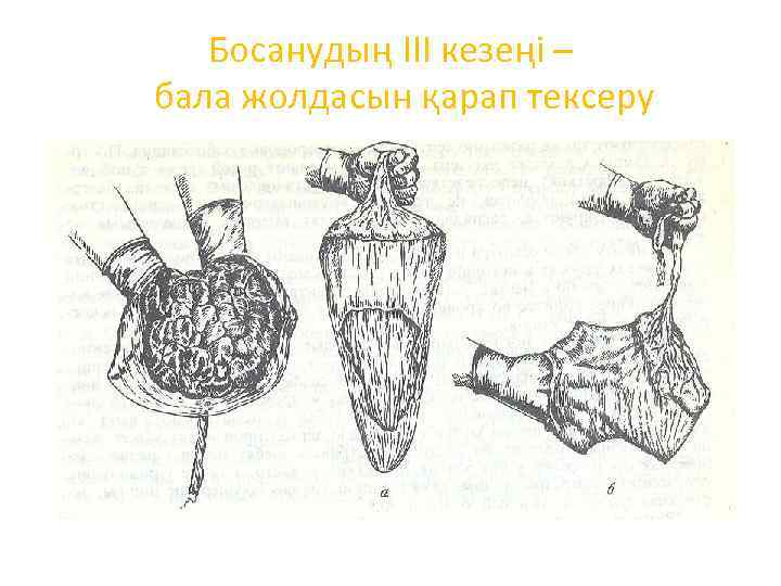 Босанудың III кезеңі – бала жолдасын қарап тексеру 