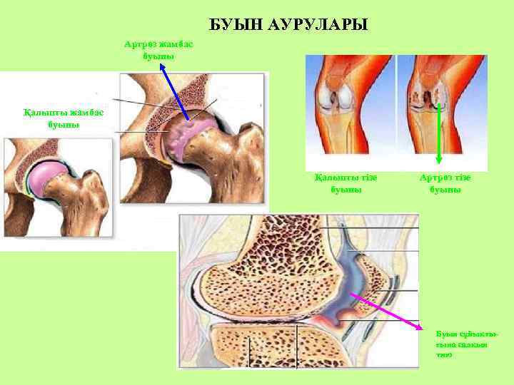 БУЫН АУРУЛАРЫ Артроз жамбас буыны Қалыпты тізе буыны Артроз тізе буыны Буын сұйықтығына салқын