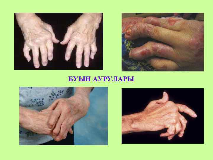 БУЫН АУРУЛАРЫ 