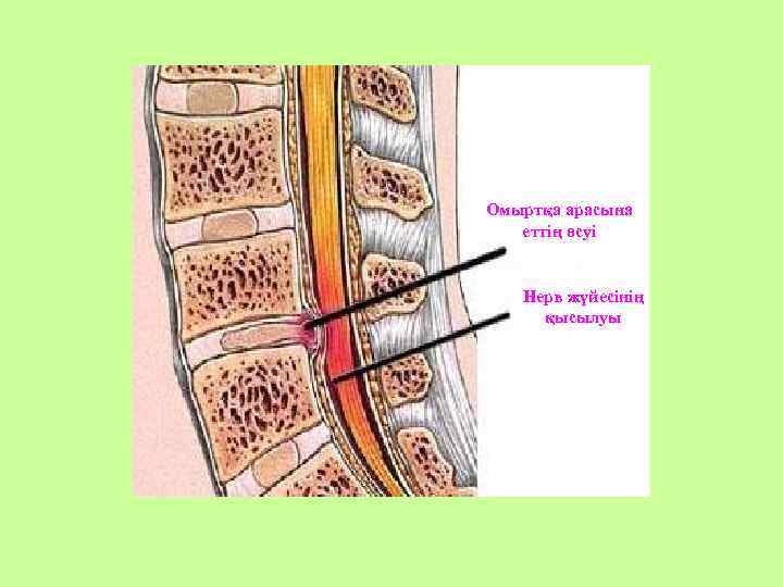 Омыртқа арасына еттің өсуі Нерв жүйесінің қысылуы 