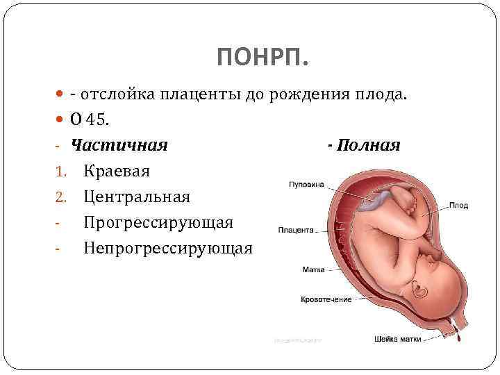 ПОНРП. - отслойка плаценты до рождения плода. О 45. - Частичная Краевая 2. Центральная