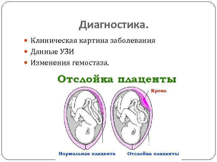 Диагностика. Клиническая картина заболевания Данные УЗИ Изменения гемостаза. 