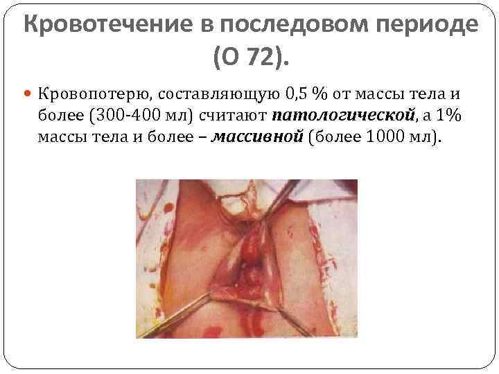 Кровотечение в последовом периоде (О 72). Кровопотерю, составляющую 0, 5 % от массы тела