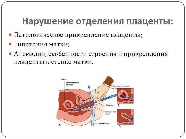 Кровотечение из матки. Причины нарушения отделения плаценты. Причины не отделения последа. Нарушение отделения последа. Отделение плаценты и выделение.