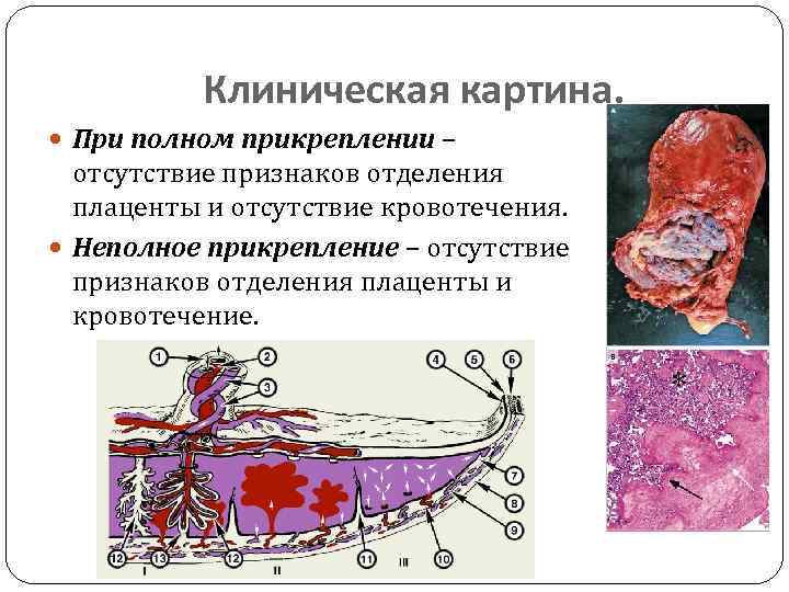 Клиническая картина. При полном прикреплении – отсутствие признаков отделения плаценты и отсутствие кровотечения. Неполное