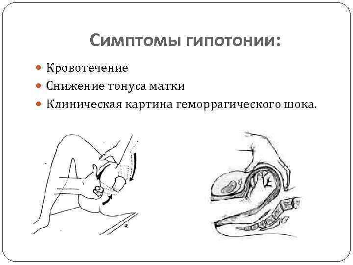 Симптомы гипотонии: Кровотечение Снижение тонуса матки Клиническая картина геморрагического шока. 