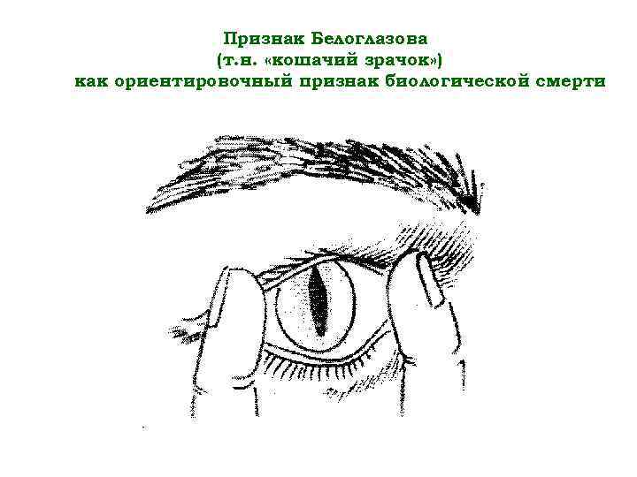 Признаки глазков. Синдром кошачьего глаза при биологической смерти. Признак Белоглазова – «феномен кошачьего зрачка». Кошачий глаз симптом клинической смерти. Кошачий глаз признак клинической смерти.